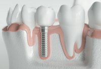Implantat